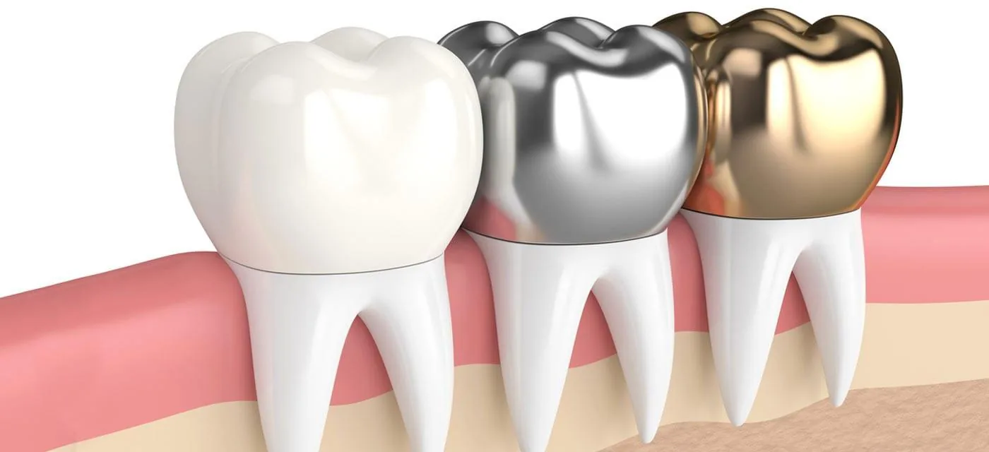 Dental crown installation in Tashkent – modern prosthetic solutions from VEDA STOM