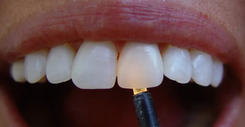 Types of zirconium crowns