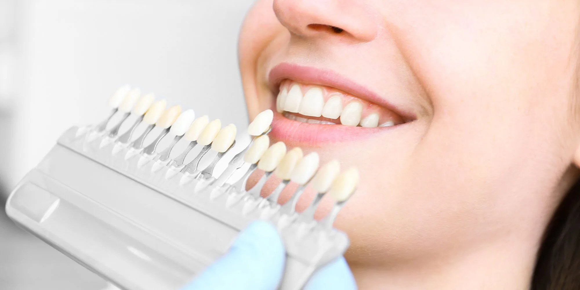 Teeth whitening in Tashkent: how to choose a method that will whiten your teeth and preserve healthy enamel