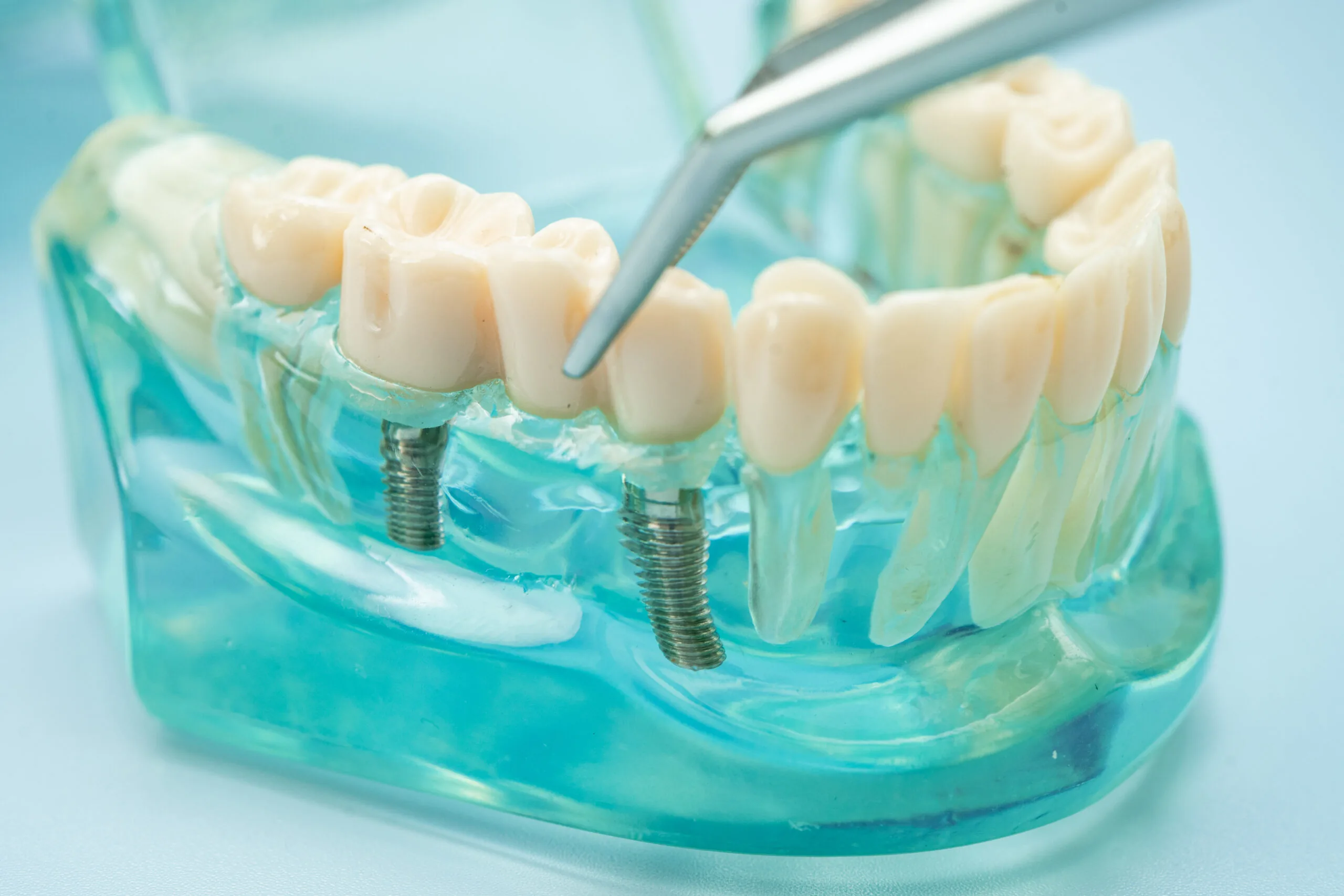 Toshkentda tayyor tish implantatsiyasi: shaffof narxlar