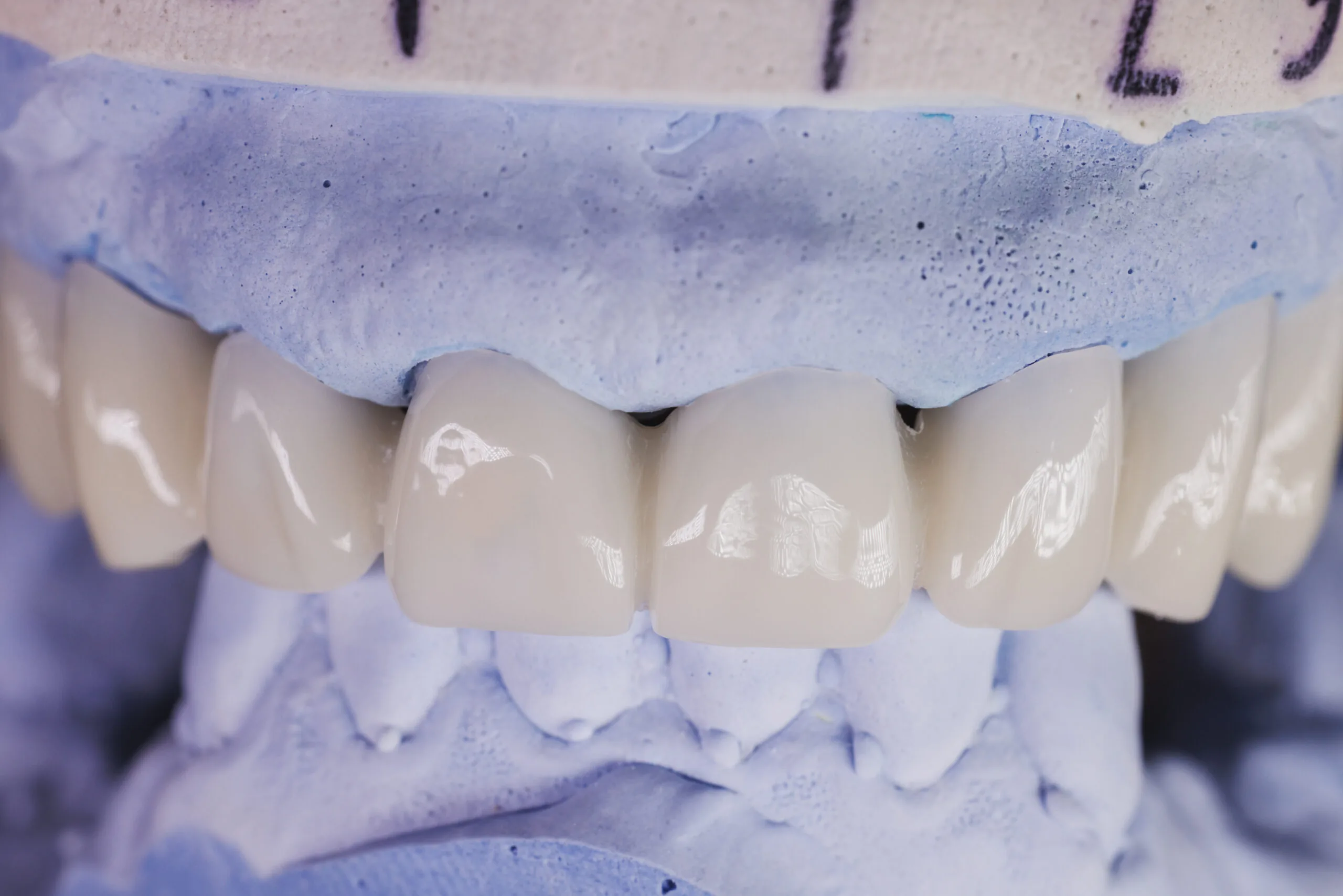 Implantlardagi tojlar: chaynash tishlari uchun qaysi biri eng yaxshisi?
