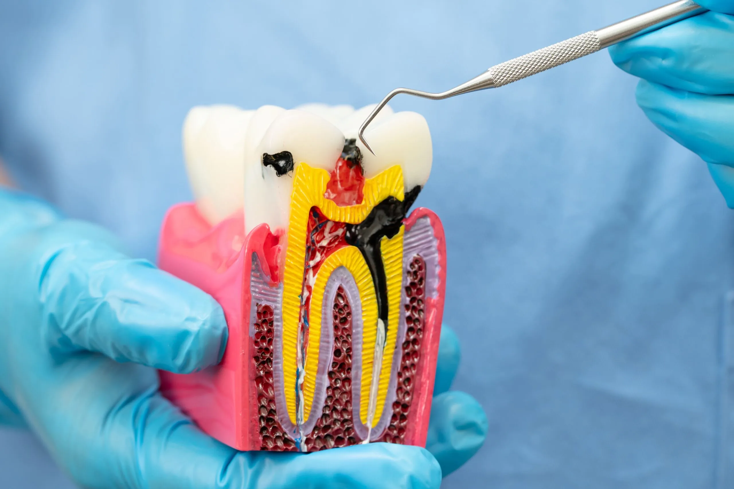 Caries treatment in Tashkent: from fillings to restoration of tooth structure